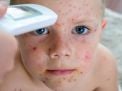 What is Mpox and how to Protect the Children in your Care